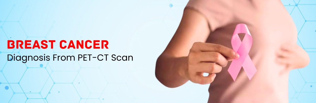 PET CT Scan for Breast Cancer